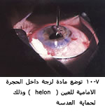 25491alsh3er.jpg