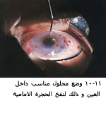 25495alsh3er.jpg